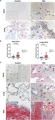 Elevated Fibronectin Levels in Profibrotic CD14+ Monocytes and CD14+ Macrophages in Systemic Sclerosis